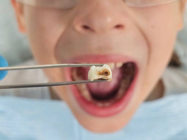 Best Emergency Dental Extractions in Hewlett Harbor, NY